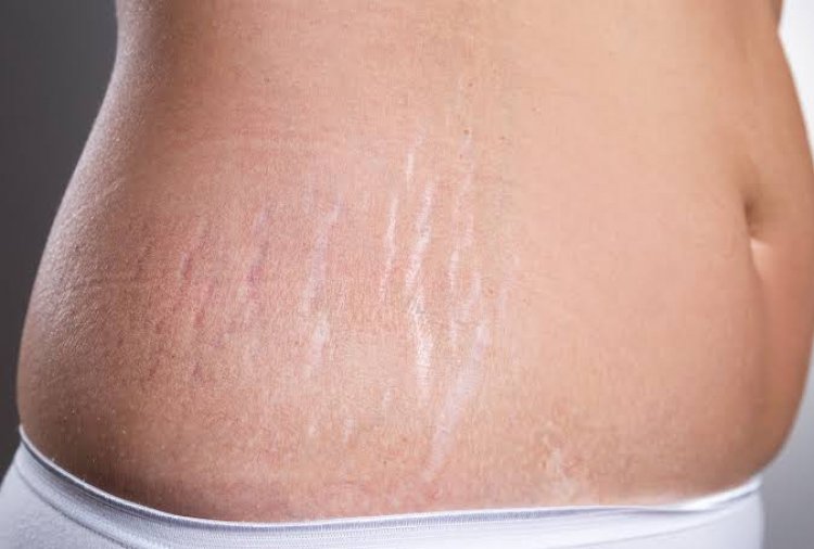 Simple Steps To Get Rid Of Stretch Marks In Your Skin