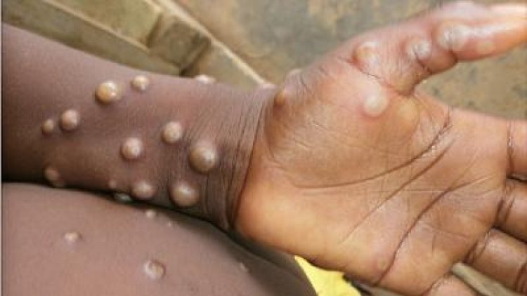 Monkeypox: How do you Get Infected, Symptoms and What are the Risks?