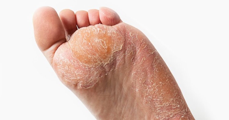 How to Remove Hard Skin On Your Feet